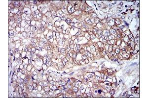 Immunohistochemical analysis of paraffin-embedded lung cancer tissues using NEFL mouse mAb with DAB staining. (NEFL antibody)