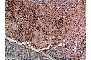 Immunohistochemical analysis of paraffin-embedded human-lung-cancer, antibody was diluted at 1:200 (DDR2 antibody  (AA 31-80))