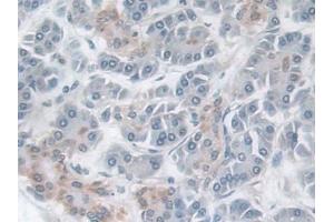 DAB staining on IHC-P; Samples: Human Pancreatic cancer Tissue (TACR2 antibody  (AA 92-290))