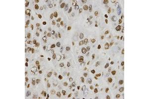 Immunohistochemistry of paraffin-embedded human liver cancer tissue using H3R8me2s antibody at dilution of 1:200 (x400 lens). (Histone 3 antibody  (H3R8me2s))