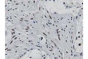 Immunohistochemical staining of paraffin-embedded Carcinoma of Human kidney tissue using anti-NT5DC1 mouse monoclonal antibody.