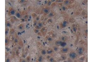 Detection of CS in Human Liver cancer Tissue using Polyclonal Antibody to Citrate Synthase (CS) (CS antibody  (AA 103-394))
