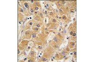 Formalin-fixed and paraffin-embedded human hepatocarcinoma tissue reacted with APOA5 antibody (N-term), which was peroxidase-conjugated to the secondary antibody, followed by DAB staining. (APOA5 antibody  (N-Term))