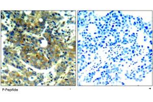 Immunohistochemical analysis of paraffin-embedded human breast carcinoma tissue using RPS6KB1 (phospho S411) polyclonal antibody . (RPS6KB1 antibody  (pSer411))