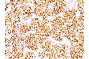 Formalin-fixed, paraffin-embedded human Renal Cell Carcinoma stained with PNA Mouse Monoclonal Antibody (PN-15). (CA9 antibody)