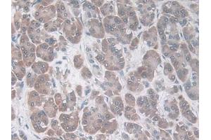 DAB staining on IHC-P; Samples: Human Breast cancer Tissue) (CCL20 antibody  (AA 27-96))