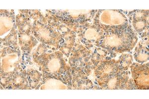 Immunohistochemistry of paraffin-embedded Human thyroid cancer using EVA1A Polyclonal Antibody at dilution of 1:30 (TMEM166 antibody)