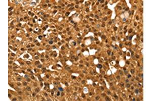 The image on the left is immunohistochemistry of paraffin-embedded Human breast cancer tissue using ABIN7192644(SRGAP1 Antibody) at dilution 1/25, on the right is treated with synthetic peptide. (SRGAP1 antibody)