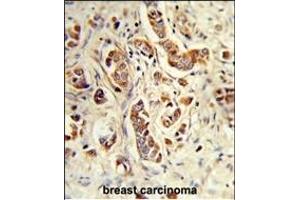 Formalin-fixed and paraffin-embedded human breast carcinoma reacted with NCF1C Antibody (C-term), which was peroxidase-conjugated to the secondary antibody, followed by DAB staining. (NCF1C antibody  (C-Term))
