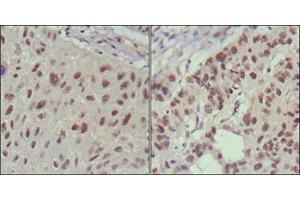 Immunohistochemical analysis of paraffin-embedded human lung cancer (left) and cervical carcinoma (right), showing nuclear localization using ISL1 mouse mAb with DAB staining. (ISL1 antibody)