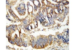 IHC-P: Calretinin antibody testing of human rectal cancer tissue