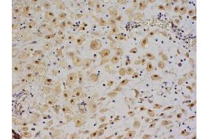 Formalin-fixed and paraffin embedded human pancreas labeled with Anti-IGF II/IGF2 Polyclonal Antibody, Unconjugated (ABIN723620), followed by conjugation to the secondary antibody and DAB staining