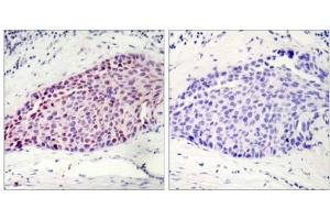 Immunohistochemical analysis of paraffin-embedded human breast carcinoma tissue using ATF-2 (Ab-112 or 94) antibody (E021033). (ATF2 antibody)