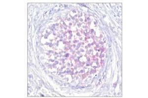 Immunohistochemical analysis of paraffin-embedded human breast carcinoma tissue using Raf-1 (phospho-Ser259) antibody (E011006). (RAF1 antibody  (pSer259))
