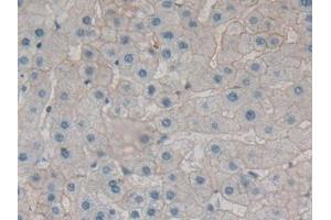 Detection of SPTAN1 in Human Liver cancer Tissue using Polyclonal Antibody to Alpha-Fodrin (SPTAN1) (SPTAN1 antibody  (AA 289-408))