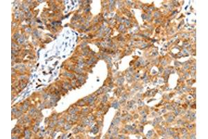The image on the left is immunohistochemistry of paraffin-embedded Human ovarian cancer tissue using ABIN7192287(SCT Antibody) at dilution 1/40, on the right is treated with synthetic peptide. (Secretin antibody)
