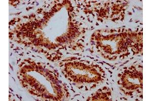 IHC image of ABIN7127740 diluted at 1:100 and staining in paraffin-embedded human breast cancer performed on a Leica BondTM system. (Recombinant Retinoblastoma 1 antibody  (pSer780))