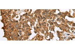 Immunohistochemistry of paraffin-embedded Human ovarian cancer tissue using YBX1 Polyclonal Antibody at dilution of 1:25(x200) (YBX1 antibody)