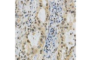 Immunohistochemical analysis of POLR3A staining in human lung cancer formalin fixed paraffin embedded tissue section. (POLR3A antibody  (N-Term))