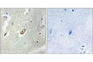 Immunohistochemistry analysis of paraffin-embedded human breast carcinoma tissue, using CDC16/APC6 (Ab-560) Antibody. (CDC16 antibody  (AA 526-575))
