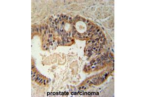 Formalin-fixed and paraffin-embedded human prostate carcinomareacted with DYRK1A polyclonal antibody , which was peroxidase-conjugated to the secondary antibody, followed by AEC staining. (DYRK1A antibody  (N-Term))