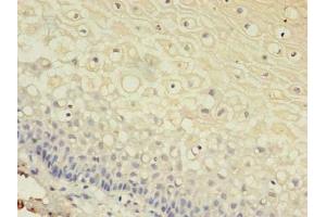 Immunohistochemistry of paraffin-embedded human cervical cancer using ABIN7153613 at dilution of 1:100 (Connexin 31 antibody  (AA 211-270))
