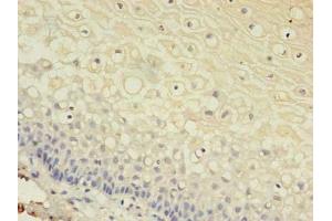 Immunohistochemistry of paraffin-embedded human cervical cancer using ABIN7153613 at dilution of 1:100