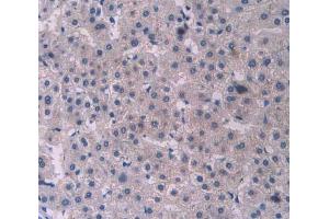 IHC-P analysis of liver cancer tissue, with DAB staining. (PCOLCE antibody  (AA 315-437))