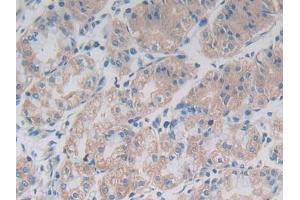 IHC-P analysis of Human Breast cancer Tissue, with DAB staining.