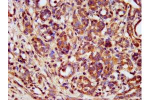 IHC image of ABIN7159577 diluted at 1:400 and staining in paraffin-embedded human pancreatic cancer performed on a Leica BondTM system. (METAP1 antibody  (AA 54-125))