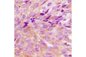 Immunohistochemical analysis of GNA13 staining in human breast cancer formalin fixed paraffin embedded tissue section.