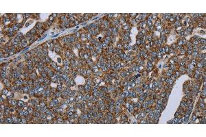 Immunohistochemistry of paraffin-embedded Human ovarian cancer using NDUFA13 Polyclonal Antibody at dilution of 1:50 (NDUFA13 antibody)