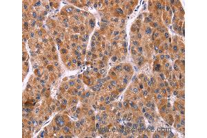 Immunohistochemistry of Human gastric cancer using EFNA5 Polyclonal Antibody at dilution of 1:40