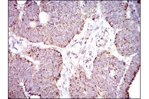 Immunohistochemical analysis of paraffin-embedded rectum cancer tissues using ALDH2 mouse mAb with DAB staining. (ALDH2 antibody  (AA 317-517))