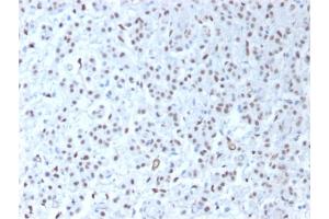 Formalin-fixed, paraffin-embedded human Mesothelioma stained with Wilm's Tumor Rabbit Recombinant Monoclonal Antibody (WT1/1434R). (Recombinant WT1 antibody)