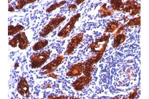 Formalin-fixed, paraffin-embedded human Thyroid stained with Thyroglobulin Monoclonal Antibody (2H11). (Thyroglobulin antibody)