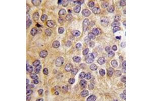 IHC analysis of FFPE human prostate carcinoma tissue stained with PRMT3 antibody (PRMT3 antibody  (AA 142-173))