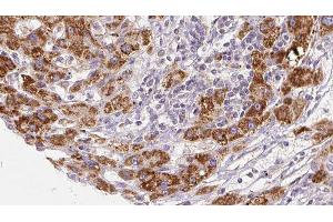ABIN6277936 at 1/100 staining Human liver cancer tissue by IHC-P. (PNPLA2 antibody  (Internal Region))