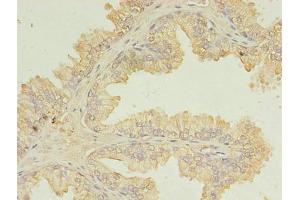 Immunohistochemistry of paraffin-embedded human prostate cancer using ABIN7174434 at dilution of 1:100 (UBE2D1 antibody  (AA 1-147))