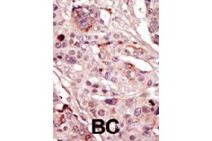 Formalin-fixed and paraffin-embedded human cancer tissue reacted with SRMS polyclonal antibody  , which was peroxidase-conjugated to the secondary antibody, followed by AEC staining. (SRMS antibody  (C-Term))