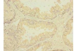 Immunohistochemistry of paraffin-embedded human prostate cancer using ABIN7168448 at dilution of 1:100 (RGR antibody  (AA 152-291))