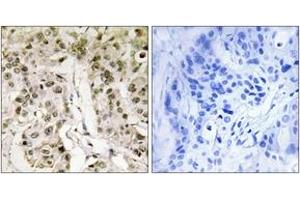 Immunohistochemistry analysis of paraffin-embedded human breast carcinoma tissue, using HCFC1 Antibody. (HCFC1 antibody  (AA 131-180))