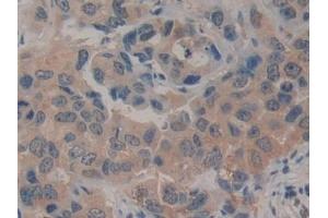 Detection of CD161 in Human Breast cancer Tissue using Polyclonal Antibody to Cluster Of Differentiation 161 (CD161) (CD161 antibody  (AA 73-188))