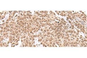 Immunohistochemistry of paraffin-embedded Human ovarian cancer tissue using ZNF560 Polyclonal Antibody at dilution of 1:25(x200) (ZNF560 antibody)