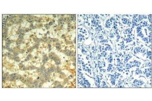 Immunohistochemical analysis of paraffin-embedded human breast carcinoma tissue using syk(Phospho-Tyr323) Antibody(left) or the same antibody preincubated with blocking peptide(right). (SYK antibody  (pTyr323))