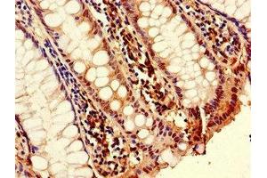 Immunohistochemistry of paraffin-embedded human colon cancer using ABIN7173790 at dilution of 1:100 (RANKL antibody  (AA 73-306))