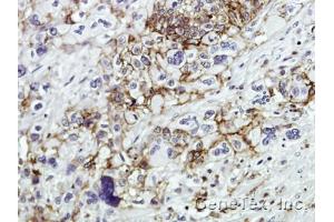 IHC-P Image Immunohistochemical analysis of paraffin-embedded Human pancreatic tumor, using CD44, antibody at 1:100 dilution. (CD44 antibody)