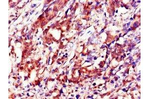Immunohistochemistry of paraffin-embedded human gastric cancer using ABIN7156360 at dilution of 1:100