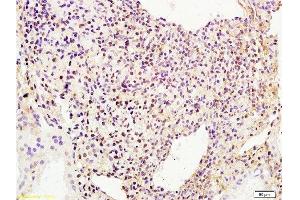 Formalin-fixed and human breast carcinoma tissue labeled with Anti-phospho-BACH1/BRIP1(Ser990) Polyclonal Antibody, Unconjugated  at 1:200 followed by conjugation to the secondary antibody and DAB staining (BRIP1 antibody  (pSer990))
