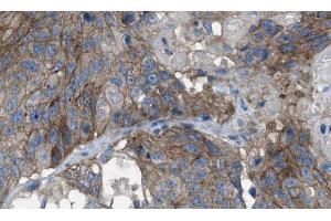 ABIN6269074 at 1/100 staining human breast tissues sections by IHC-P. (EGFR antibody  (Internal Region))